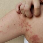 The chronic dermatitis, allergy and rash on the body.