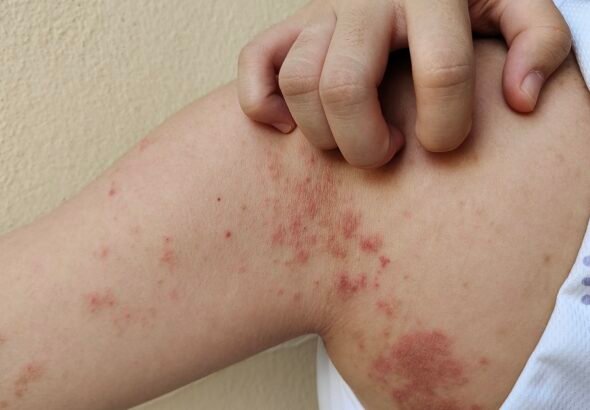 The chronic dermatitis, allergy and rash on the body.