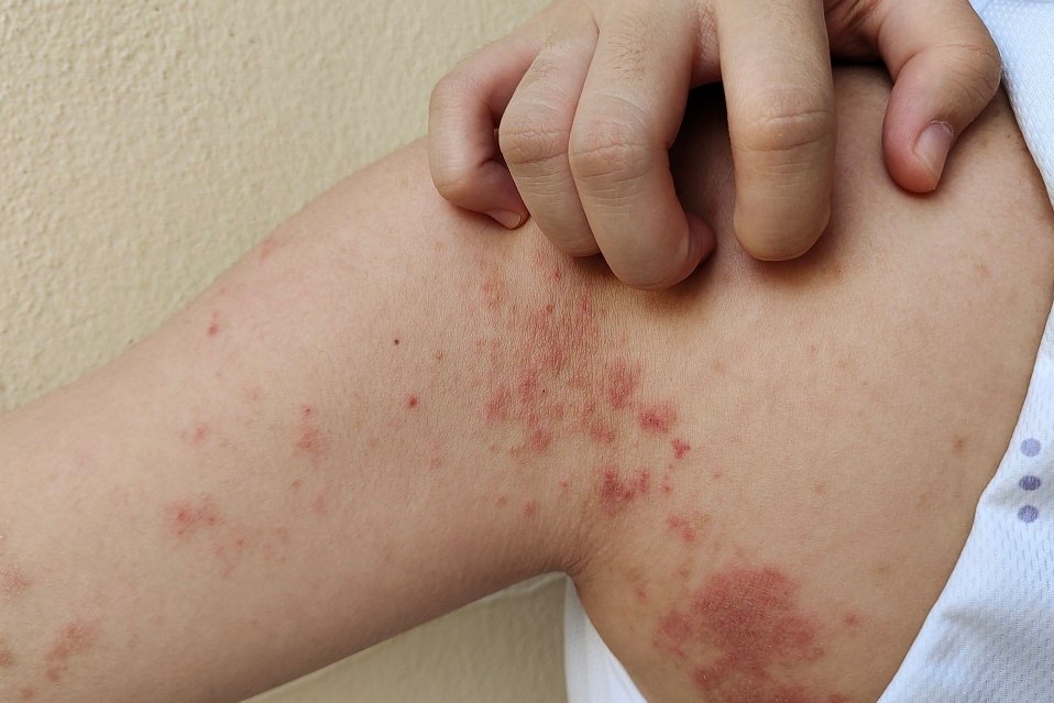 The chronic dermatitis, allergy and rash on the body.